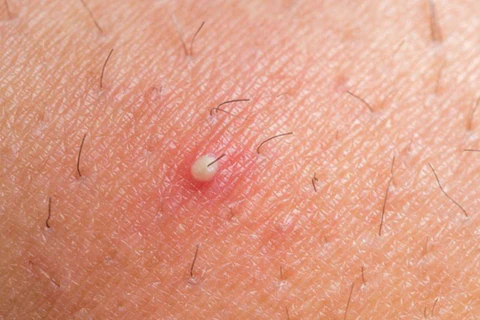 Herpes Ingrown Hair or Monkeypox How to Know the Difference