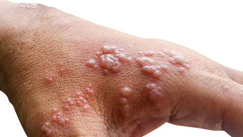 Herpes Ingrown Hair or Monkeypox How to Know the Difference